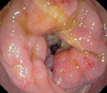 Запушване на дебелото черво - причини, симптоми, диагностика и лечение