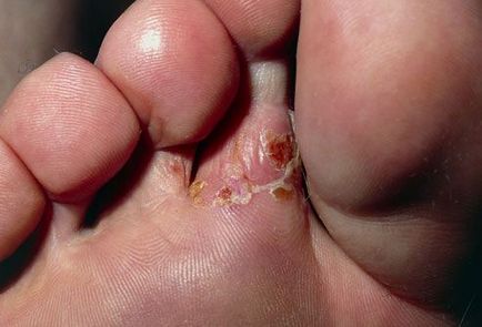 Hyperkeratosis Nail - kezelésére gomba a láb és a kéz, az orvosi oldalon