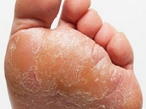 gomba foot nail foot tünetei