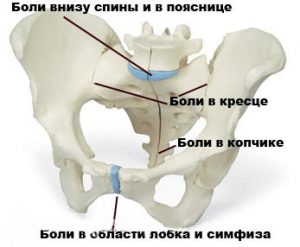 Кост по време на бременността причинява симптомите, диагностични методи, лекарства и упражнения за лечение на