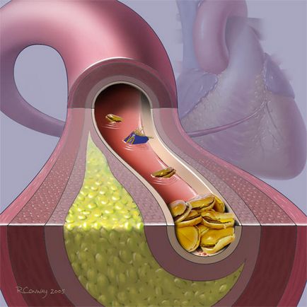 Angioplasty az alsó végtagok - kezelés a szív