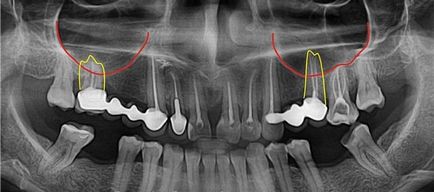sinusurilor maxilare și dinții de sus vecinătate periculoase