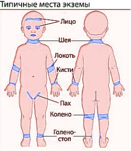 Eczema simptomelor copii, cauze si tratament