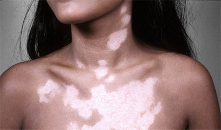 Tratamentul Vitiligo simptome foto care aceasta boala, cauzele