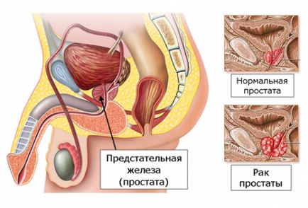 Chistul adenomului și prostatei