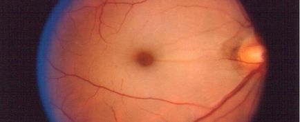 Ocluzia arterei centrale a retinei - periculoase, simptome și tratamente pe site-ul nostru