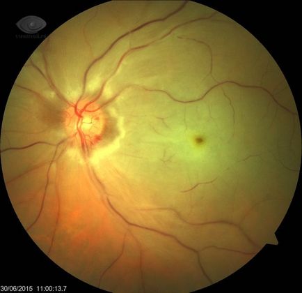 Ocluzia arterei retiniene centrale, bolile de ochi vseozrenii portal