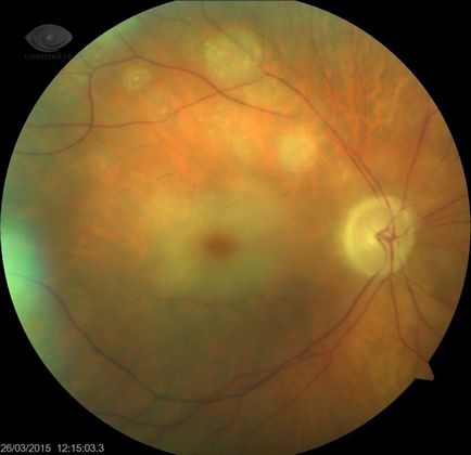 Ocluzia arterei retiniene centrale, bolile de ochi vseozrenii portal