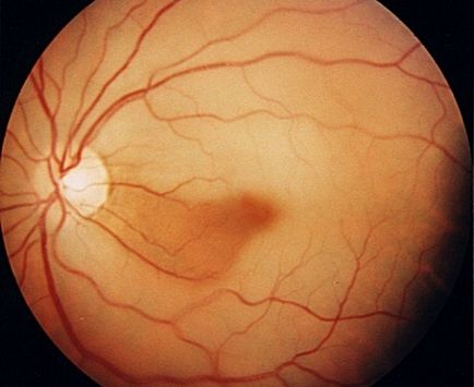 Ocluzia arterei centrale a retinei - cauze, simptome si tratament 1
