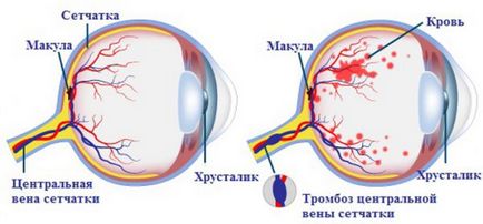 Ocluzia arterei centrale a retinei - cauze, simptome și tratament