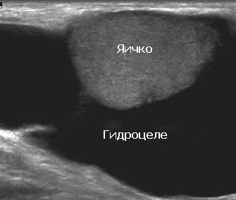 Uzi hidrocel testicular cu urolog meu