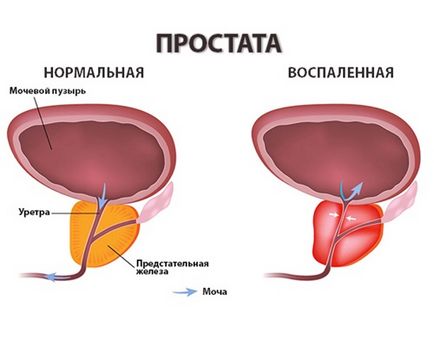 a prostatitis elektromágnes kezelése