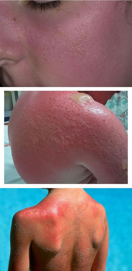 simptomele și tratamentul bolii dermatita solara, care este în pericol