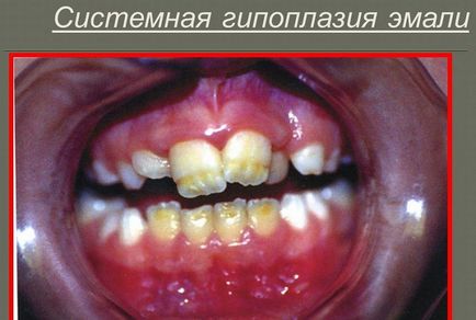 Sindromul kapdepona Stanton, și dentinogenesis imperfecta simptome amelogenesis, tratament