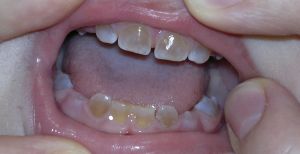 Sindromul kapdepona Stanton, și dentinogenesis imperfecta simptome amelogenesis, tratament