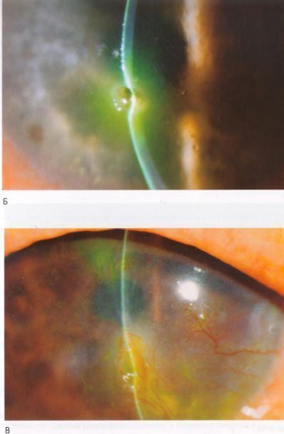 Infecții corneene - keratoconjunctivita sicca (sindromul de ochi uscat)