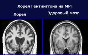 Boala Huntington simptome, diagnostic și tratament