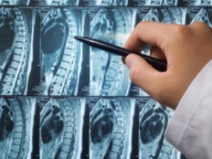 Proeminența simptomelor coloanei vertebrale, diagnostic și tratament