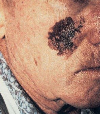 Malignus melanoma alakja és fejlesztési fázisban, komplikációk, a kezelés, megelőzés