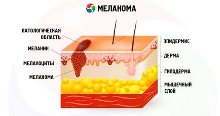 Rosszindulatú melanoma a bőr, tünetei és kezelése malignus melanoma, az illetékes