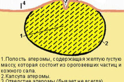 Ateromul scrotală cauze, tratament