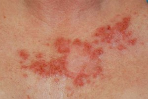 Cauzele de eroziune a pielii de simptome, semne, tratament