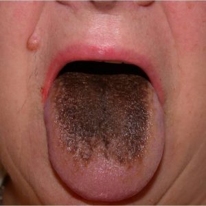 Simptomele glosita si tratamentul copilului si adultului, cauzele limbajului glosită