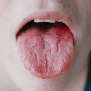 Simptomele glosita si tratamentul copilului si adultului, cauzele limbajului glosită