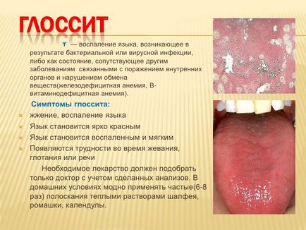 Limba glosita - fotografii, simptome și tratament, site-ul medical