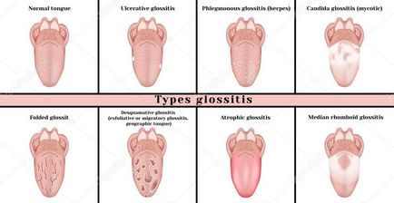 Limba glosita - fotografii, simptome și tratament, site-ul medical