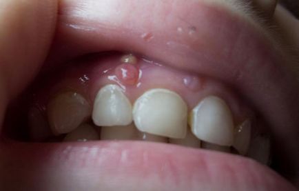 Как за лечение на фистула на венците след вадене на зъб и резекция на  главния корен