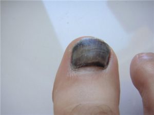 kezelés malavit gomba nail tabletták kapszulákban körömgombától