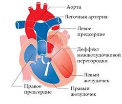 szív egészsége wpw)
