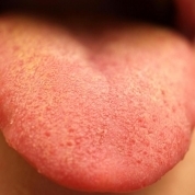 Aftele pe limba cauze, simptome și tratament