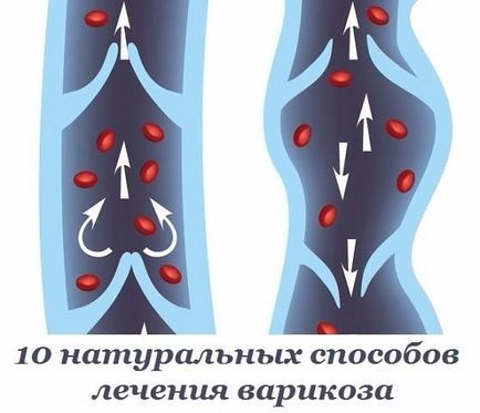 10 Metode naturale de tratament a venelor varicoase - sănătate sibiriană