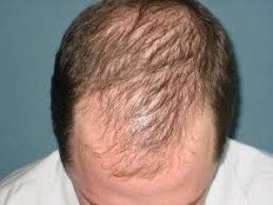 7 Причин випадіння волосся у чоловіків