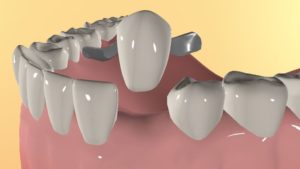 Адгезивний мостовидний протез адгезивне протезування зубів