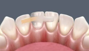 Адгезивний мостовидний протез адгезивне протезування зубів