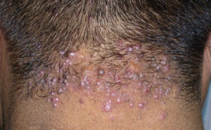 Diagnosticul de keloid acnee, tratamentul, prevenirea