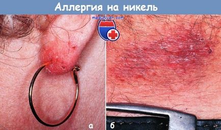 Dermatita alergică de contact pe nichel