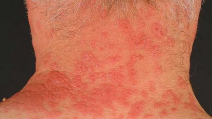 Allergiás a burgonya csecsemők, gyermekek, felnőttek megnyilvánuló tüneteket