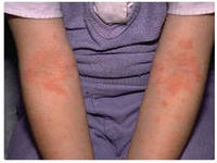 Alergie cutanată la copii și adulți