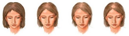 Androgenic alopecie la femei tratament, comentarii, simptome