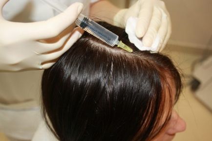 Androgenic alopecie la femei tratament, comentarii, simptome