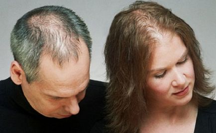 Androgenic alopecie la femei tratament, comentarii, simptome