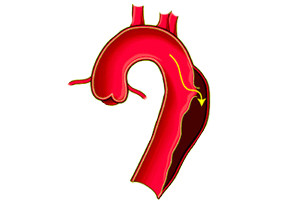 Anevrismul aortei toracice