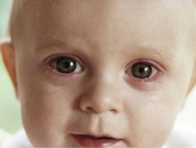 Ангіопатія сітківки ока у дитини