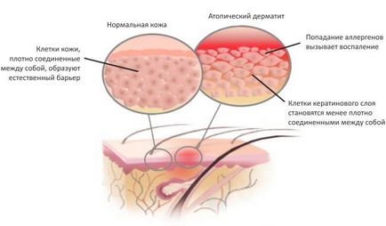 Dermatita atopica - tratamentul unei boli