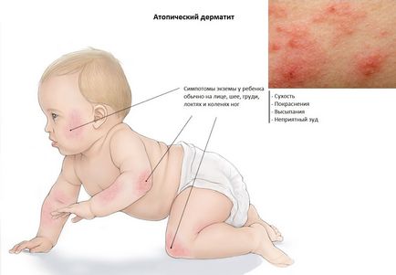 Dermatita atopica - tratamentul unei boli