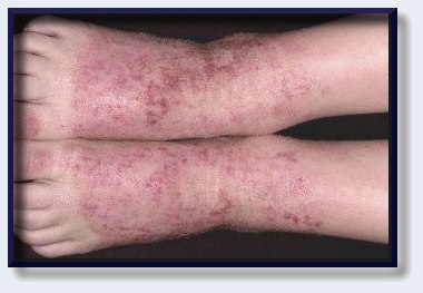 Az atópiás dermatitis kezelése népi jogorvoslat, az egészséges életmód